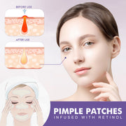 Cheek Acne Patch Anti-acne Smallpox Diluting Acne