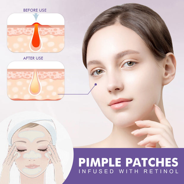 Cheek Acne Patch Anti-acne Smallpox Diluting Acne